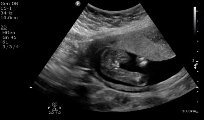 Female Sex Ultrasound Identification Of The Female Fetal Sex At First ...