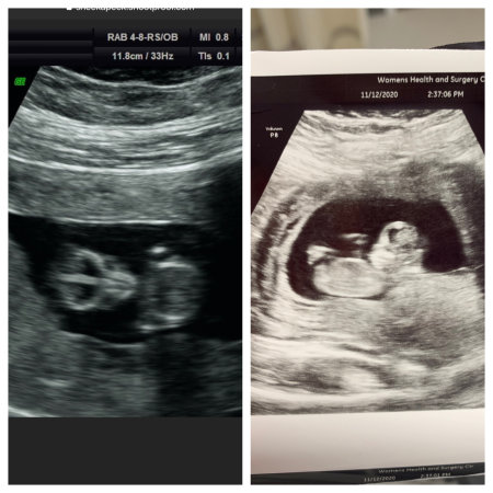 12w2d ultrasound. - Page 1 | BabyCenter