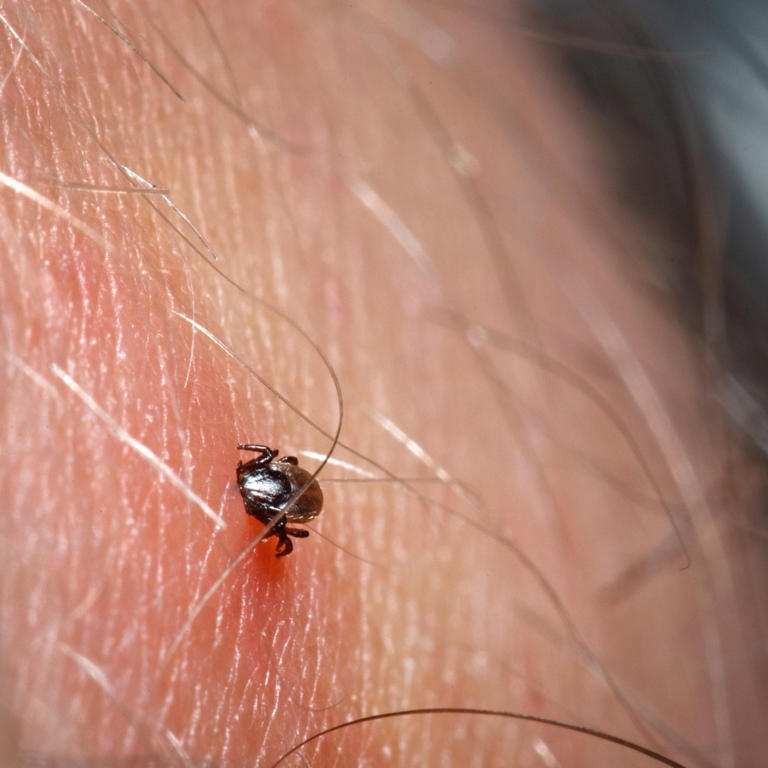 What tick bites look like and how to deal with suspected Lyme disease