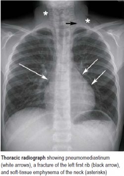 Pneumomediastinum in a Child Following Blunt Thoracic Trauma (19.08.2019)