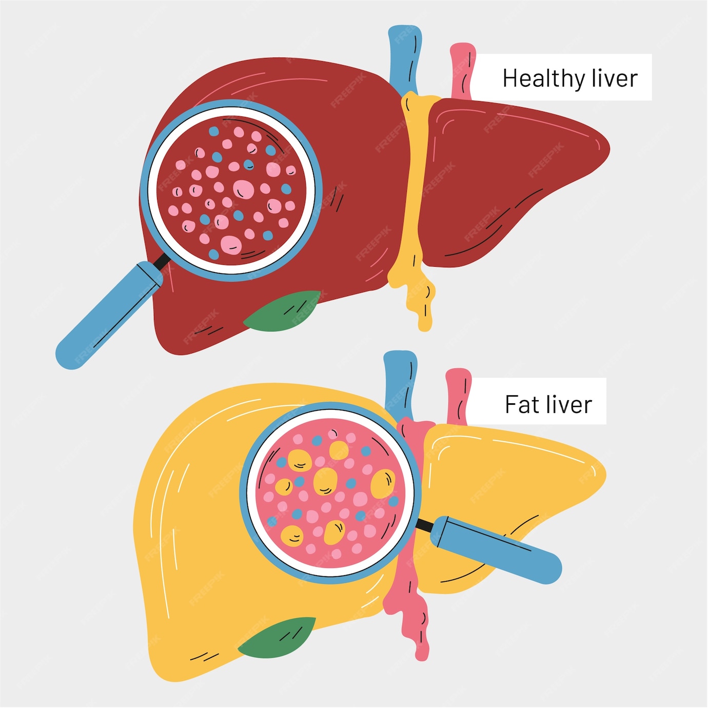 Free Vector | Hand drawn flat design fatty liver illustration