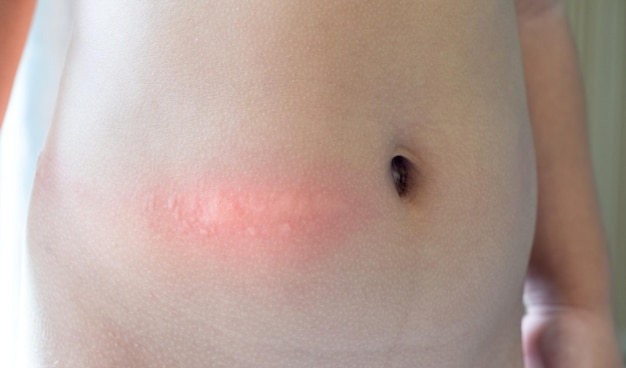 Baby waist with skin rash and allergy with red spot cause by\
mosquito bite