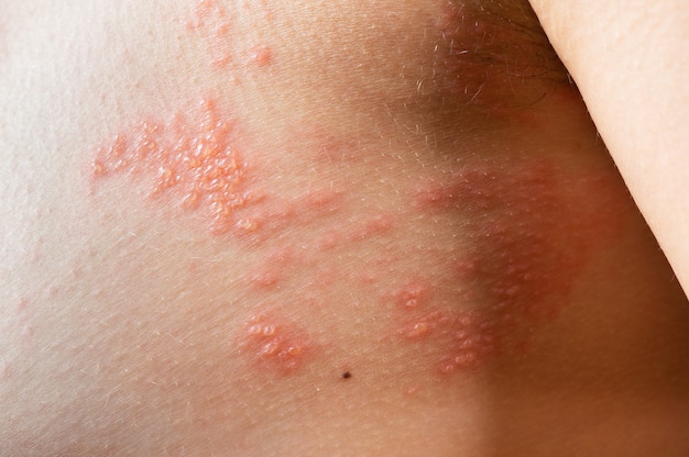 Chickenpox rash. shingles, varicella-zoster virus. skin rash\
and blisters on body. skin infected herpes zoster virus. herpes\
virus on body. urticaria rash. atopic dermatitis