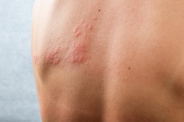 Chickenpox rash. shingles, varicella-zoster virus. skin rash\
and blisters on body. skin infected herpes zoster virus. herpes\
virus on body. urticaria rash. atopic dermatitis