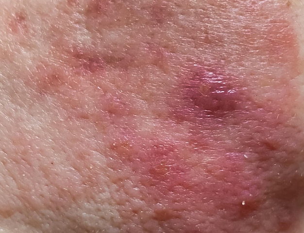 Close-up, selective focus, dermatological infection of the\
skin, in which redness and rashes on the skin of the face.