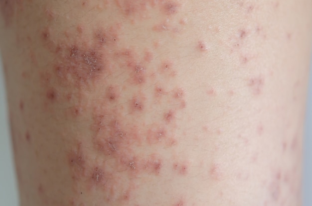 Close-up of skin rashes caused by allergies. rashes are caused\
by food allergies. concept of health care