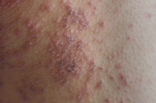 Close-up of skin rashes caused by allergies. rashes are caused\
by food allergies. concept of health care