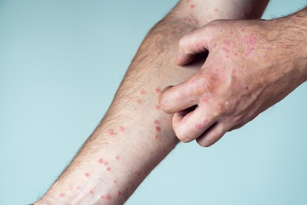 Cropped photo of man suffering from psoriasis scratching thick\
scaly clusters red rash on skin of arm with fingers