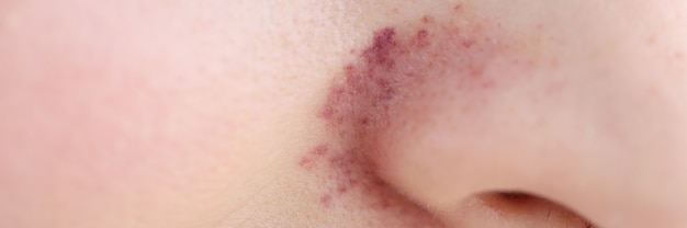 Rash on skin near woman nose closeup