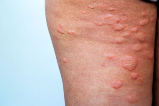 Skin rash in the legs