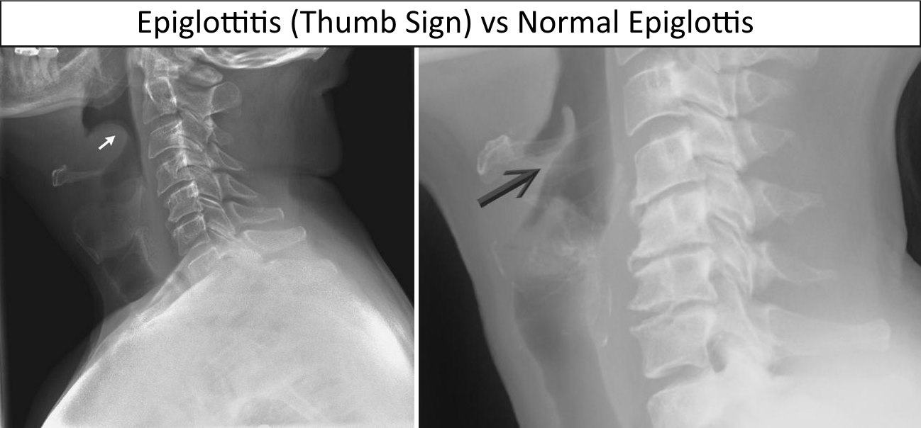 Thumb Sign Epiglottitis