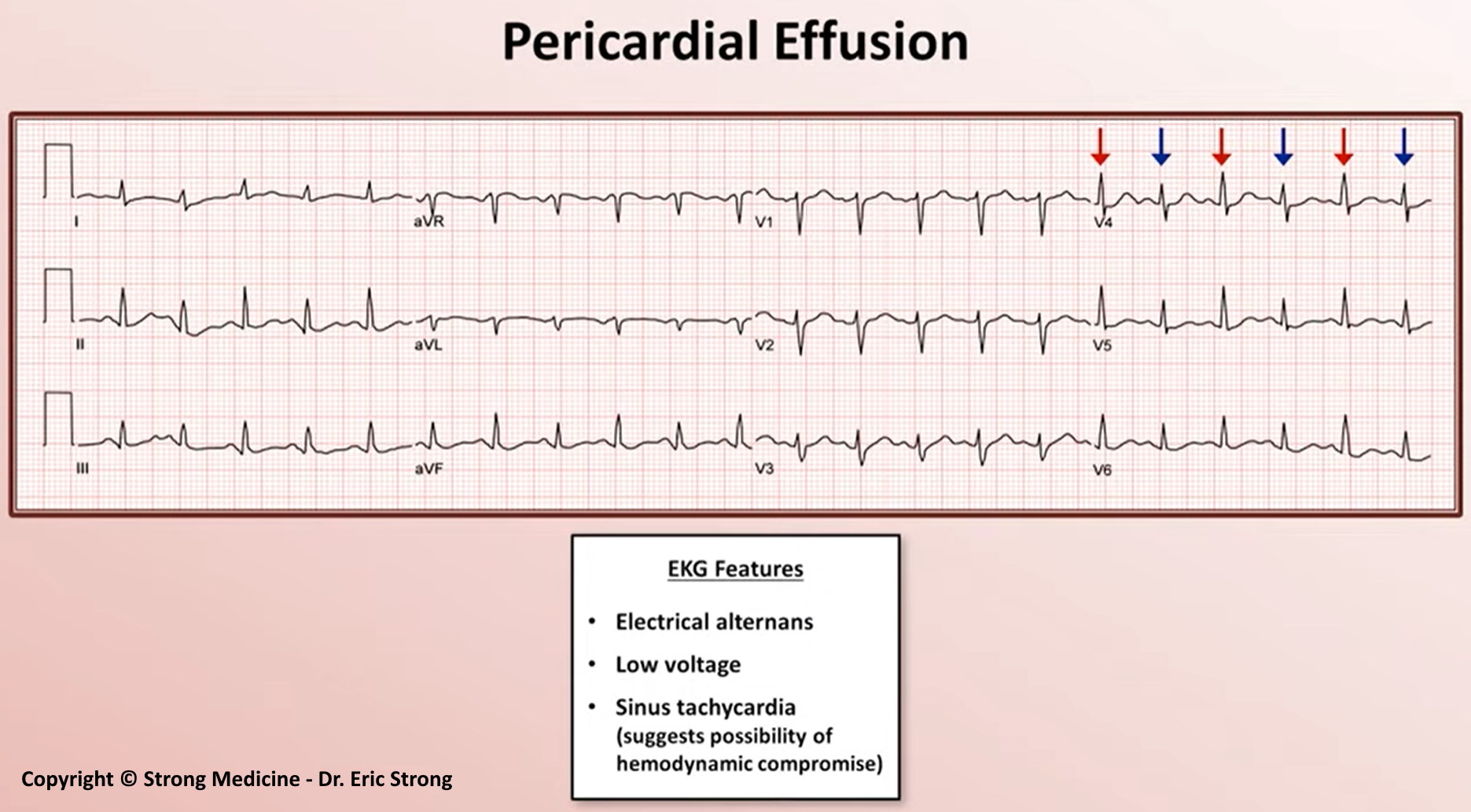 Ecg Pericardial Effusion