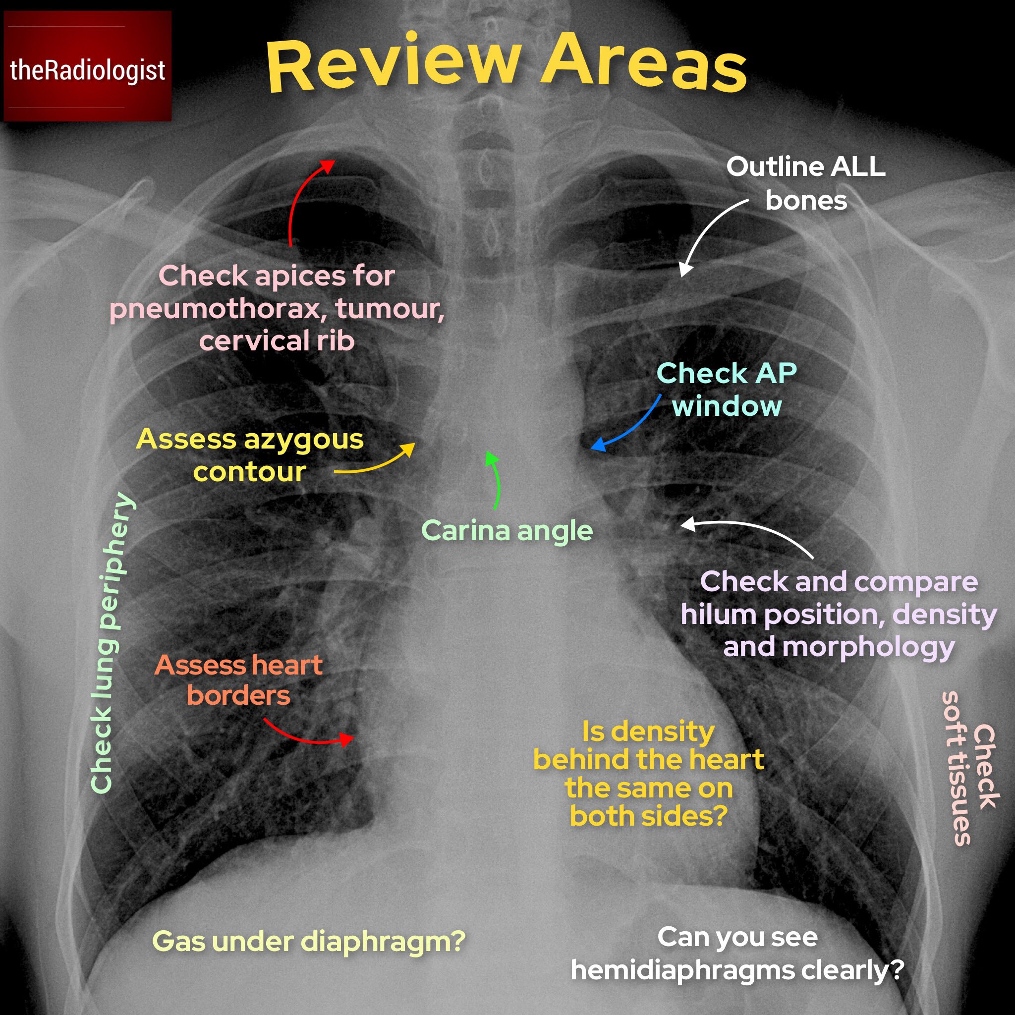 Approach To Chest X Ray And Interpretation - vrogue.co