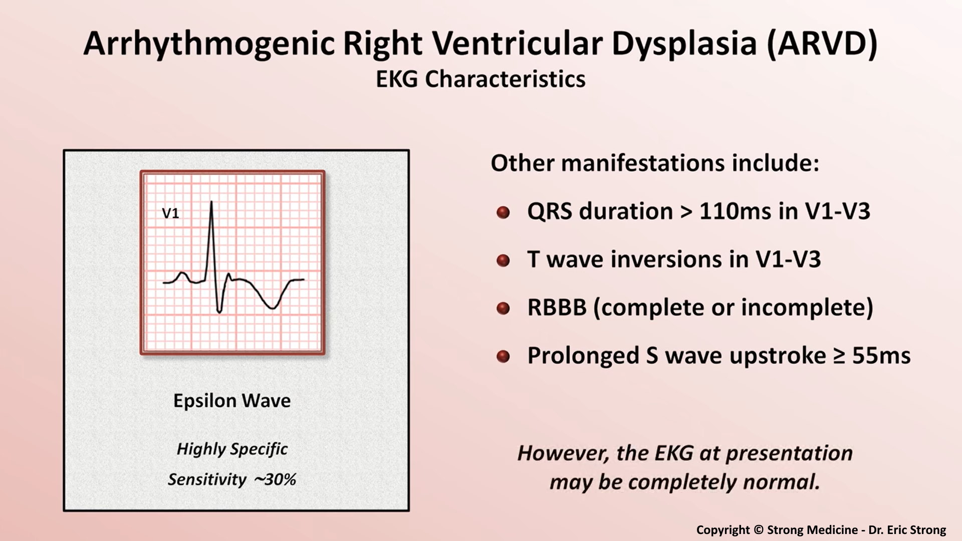 Arrhythmogenic Right Ventricular Dysplasia