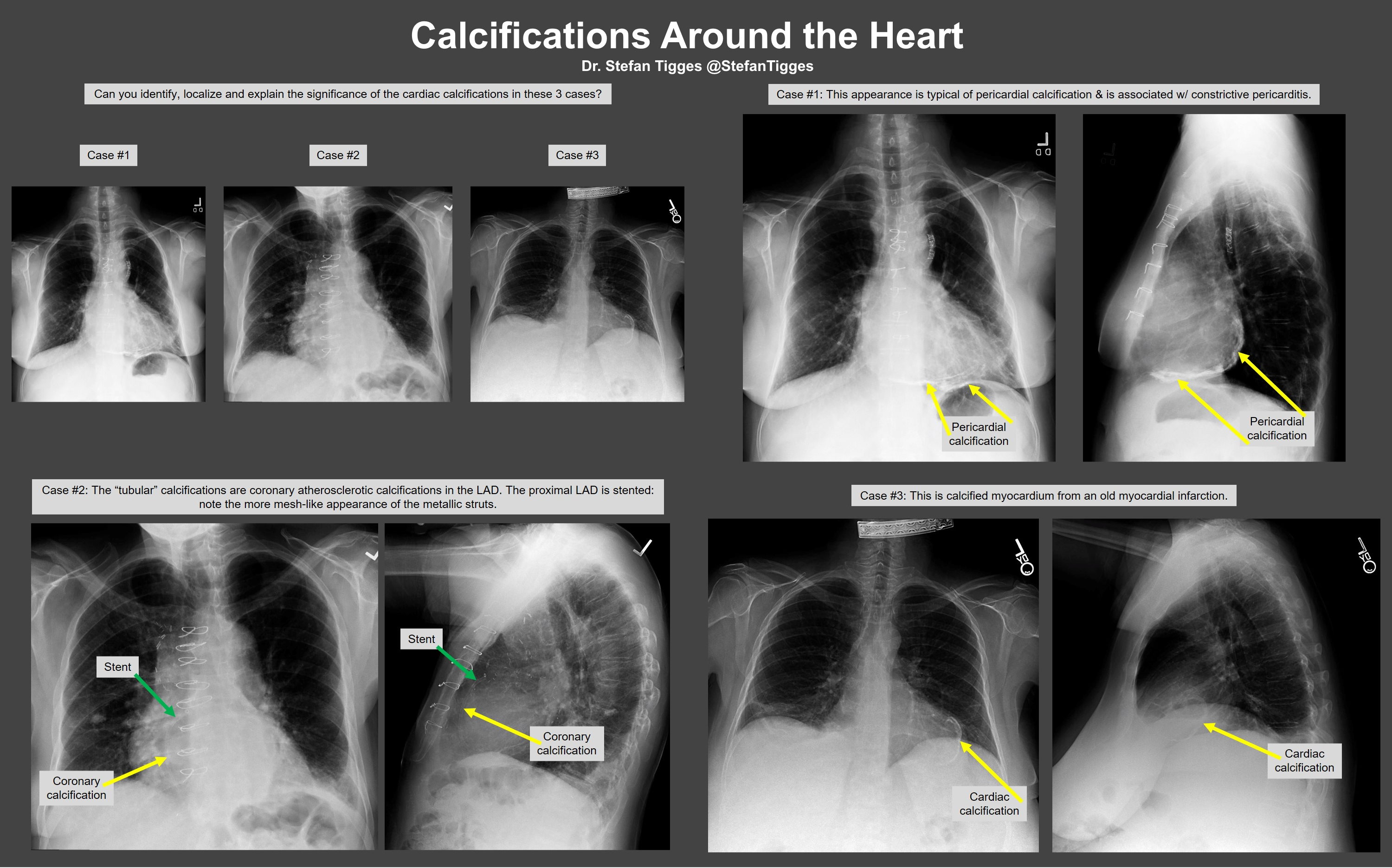 Pericarditis Chest X Ray