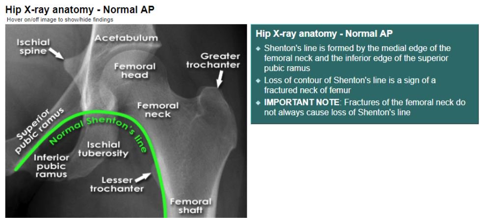 Hip X-ray anatomy - Normal AP - Shenton's line is formed ... | GrepMed