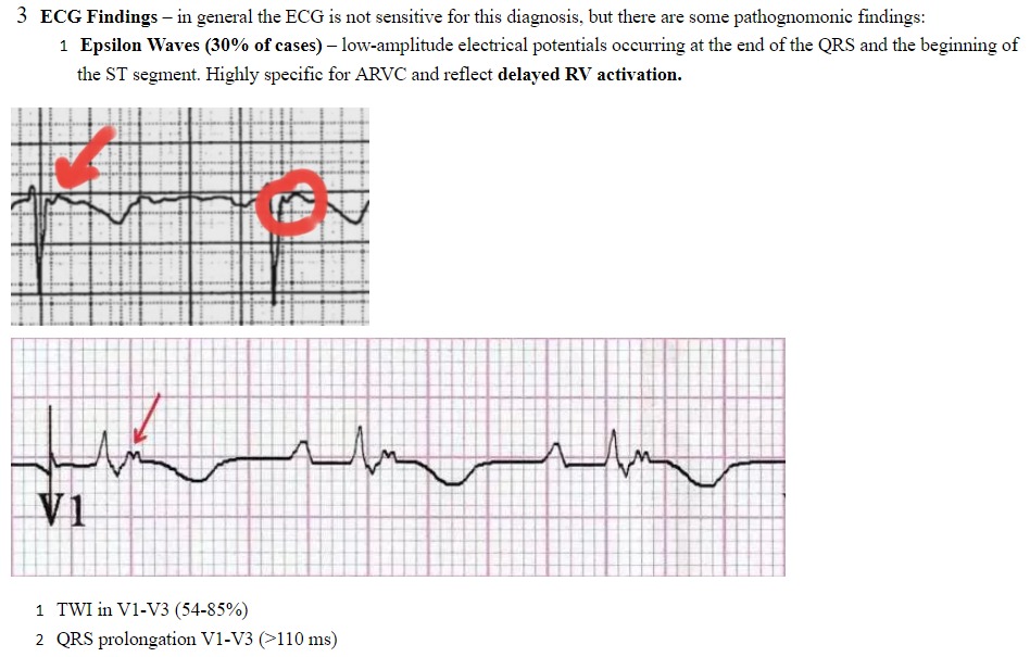 Arrhythmogenic Right Ventricular Dysplasia Ecg