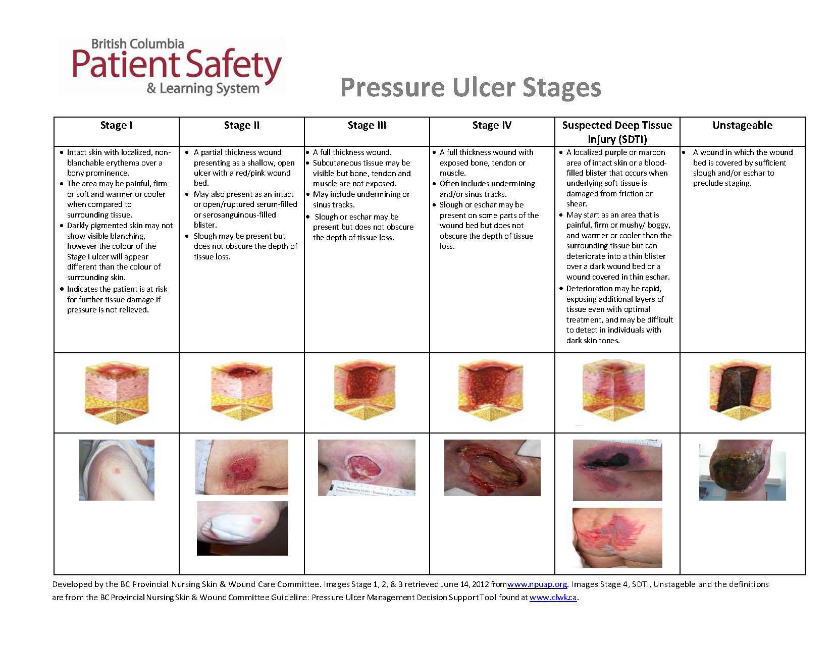 Pressure Ulcer Staging Guide