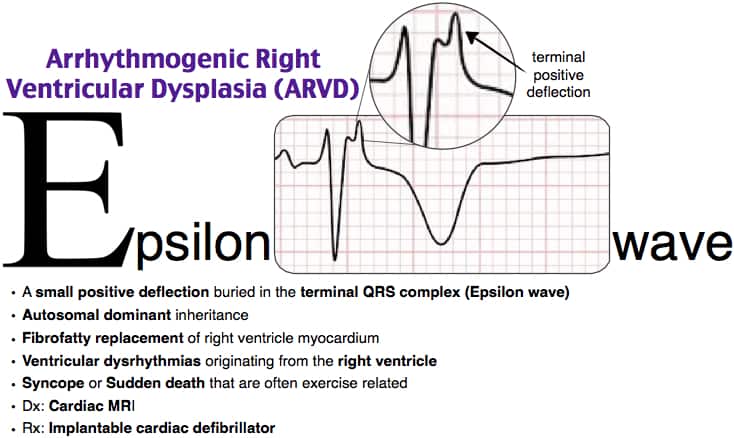 Arrhythmogenic Right Ventricular Dysplasia