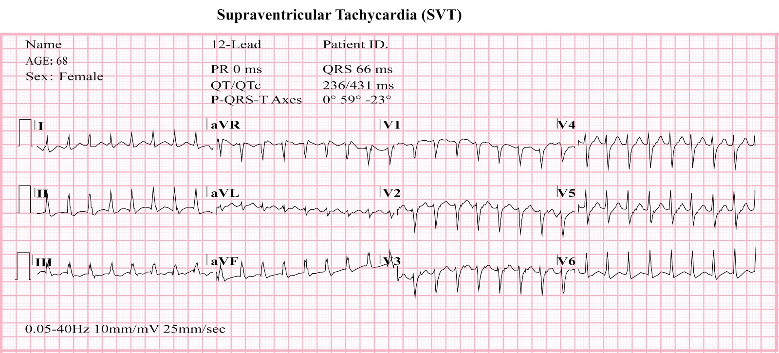 Paroxysmal Supraventricular Tachycardia