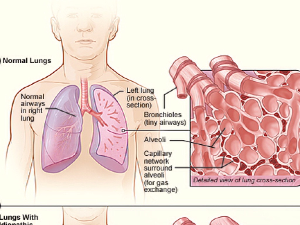 Pulmonary Fibrosis by orninpai000