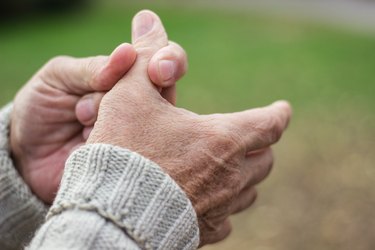 close view of a person's hands with psoriatic arthritis