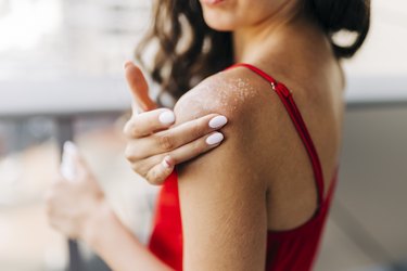 Close up of a person applying moisturizer on sunburned skin