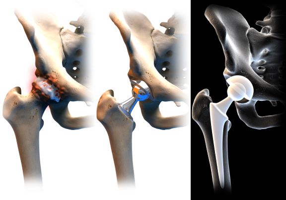 Cirurgia de Substituição do Quadril: Objetivo, Procedimento, Riscos e Recuperação