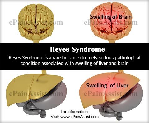 อาการของ Reye คืออะไร อาการและสาเหตุของ Reye-Johnson