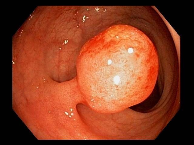 ไดเรกทอรี Colon Polyps: ค้นหาข่าวคุณสมบัติและรูปภาพที่เกี่ยวข้องกับ Colon Polyps