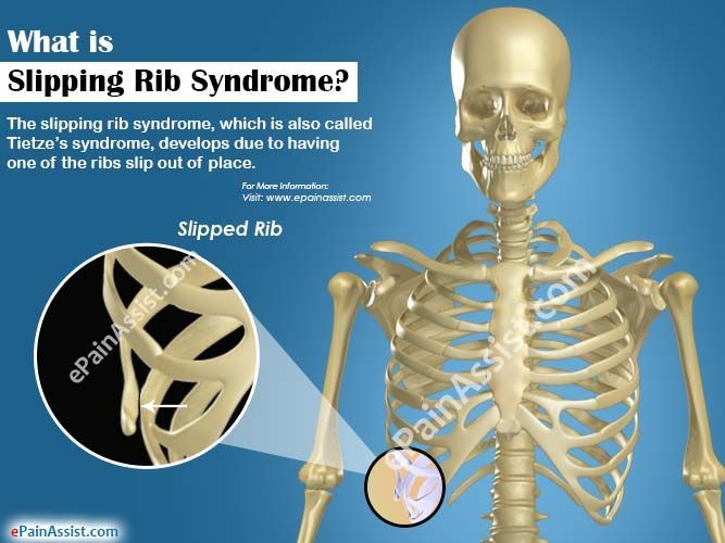 Tietze Syndrome: ทุกสิ่งที่คุณต้องรู้