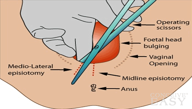 Episiotomy อาจไม่ช่วยแม่มากที่สุด