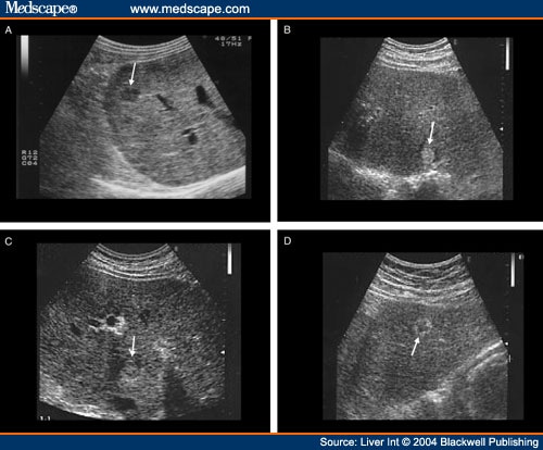 cirrhosis of the liver ultrasound | nicolas cage blogs