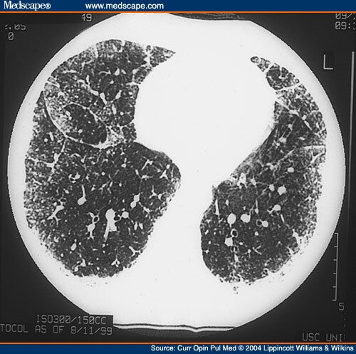 Interferon-Induced Granulomatous Lung Disease