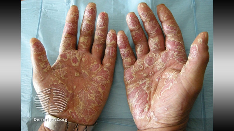 Psoriasis Palms