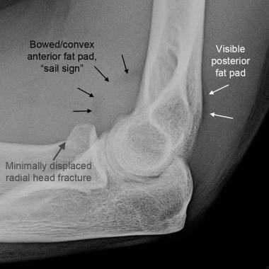 Abnormal Elbow X Ray