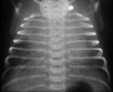 Transient Tachypnea of the Newborn: Background, Pathophysiology ...