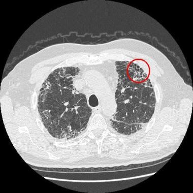 Idiopathic Pulmonary Fibrosis Honeycomb