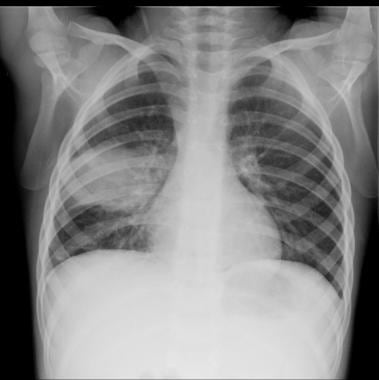 Normal Child Chest X Ray