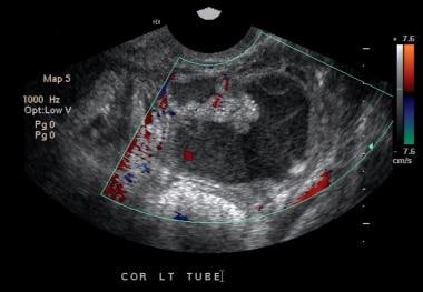 Pelvic Inflammatory Disease Ultrasound