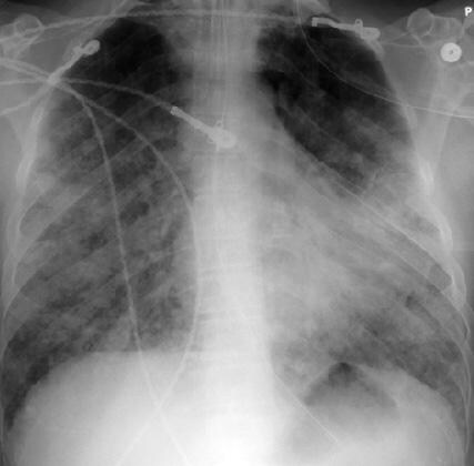 Microscopic Polyangiitis - Arthritis Rheumatism