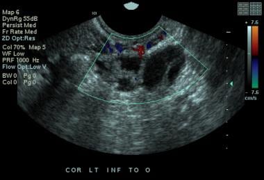 Pelvic Inflammatory Disease Ultrasound