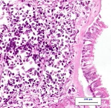 Small Cell Lung Cancer (SCLC): Practice Essentials, Pathophysiology ...