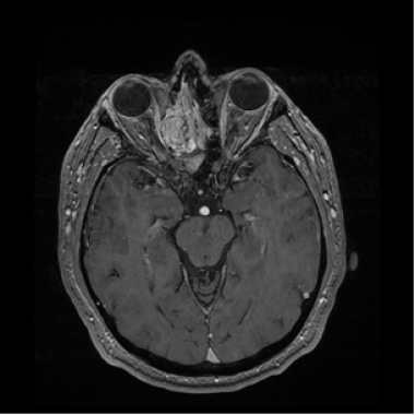 Malignant Tumors of the Nasal Cavity: Background, Epidemiology, Etiology