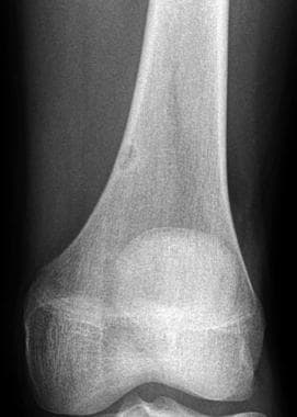 Imaging In Fibrous Cortical Defect And Nonossifying Fibroma