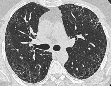 Pulmonary Fibrosis X Ray