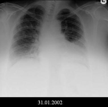 Pulmonary Fibrosis X Ray