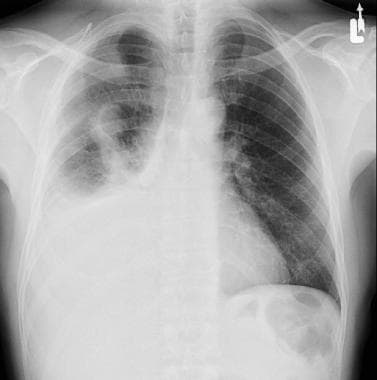 mesothelioma of pleura treatment Mesothelioma intechopen figure surgery