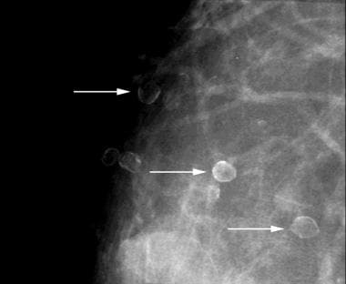 Eggshell Calcification