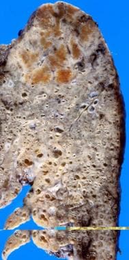 Honeycomb Lung Pathology: Definition, Epidemiology, Etiology